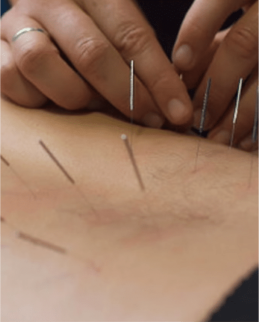 A person getting acupuncture in a seminar on their stomach.